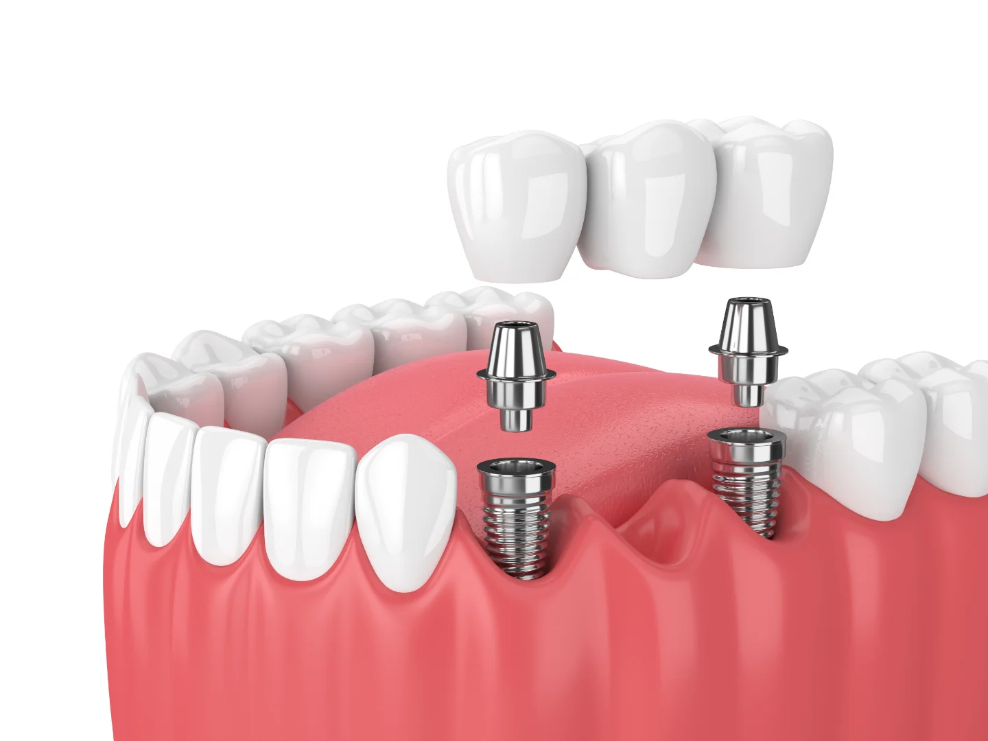 Dental implant schema