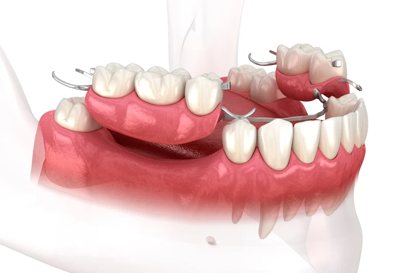 Types of dental prostheses