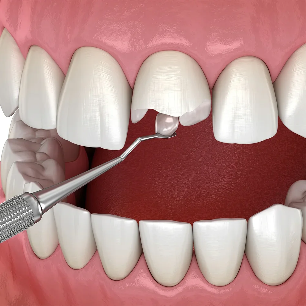 Estetinis plombavimas - rezultatas